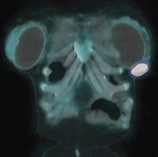 PET/CT image of invasive ductal carcinoma of the left breast